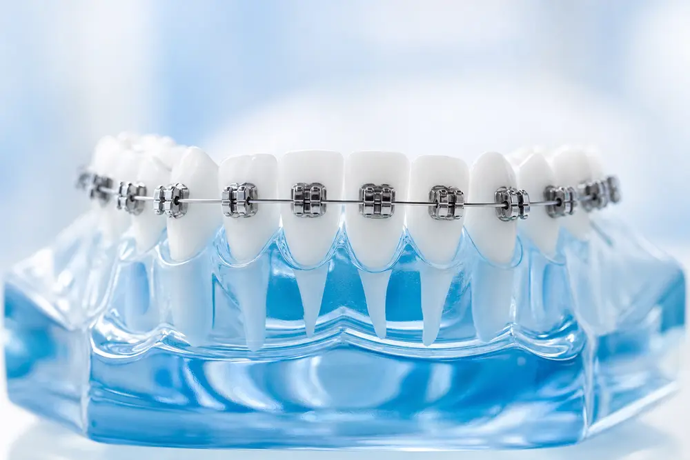 Brackets colocados en una sonrisa